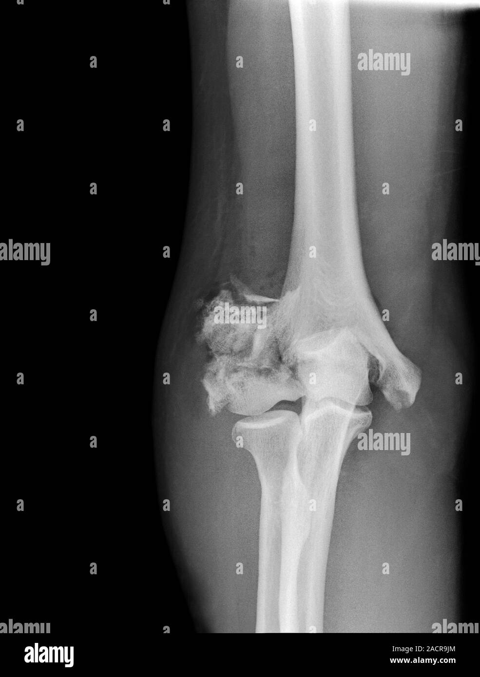 Broken elbow. Xray of the arm of a 55 year old male patient with