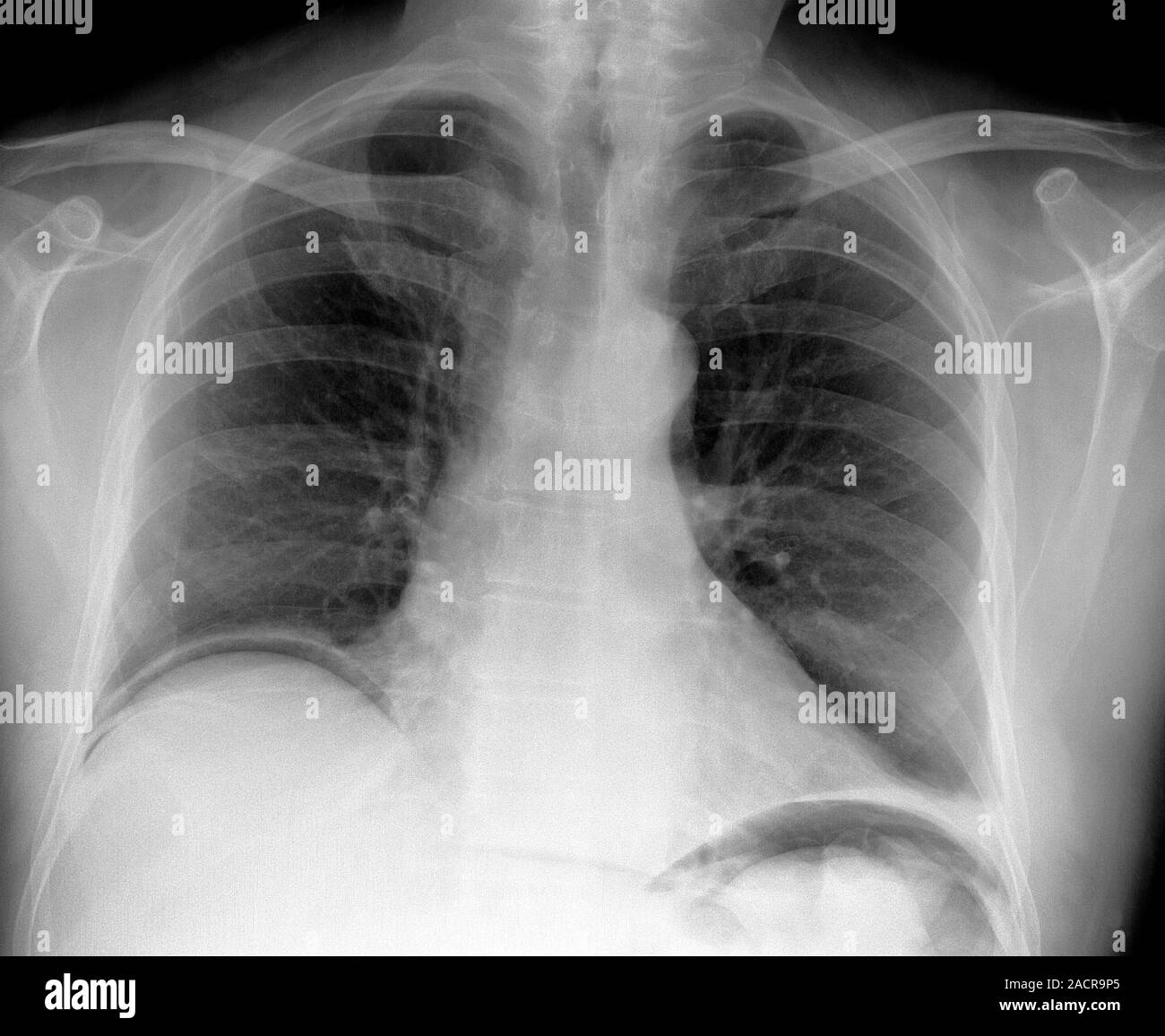 Abdominal air pockets. Chest Xray of a 74 year old male patient