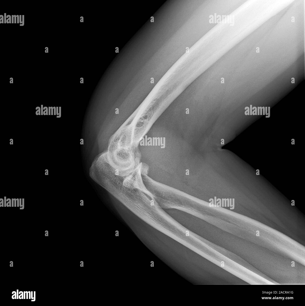 Broken elbow. Xray of the arm of a 44 year old female patient with a