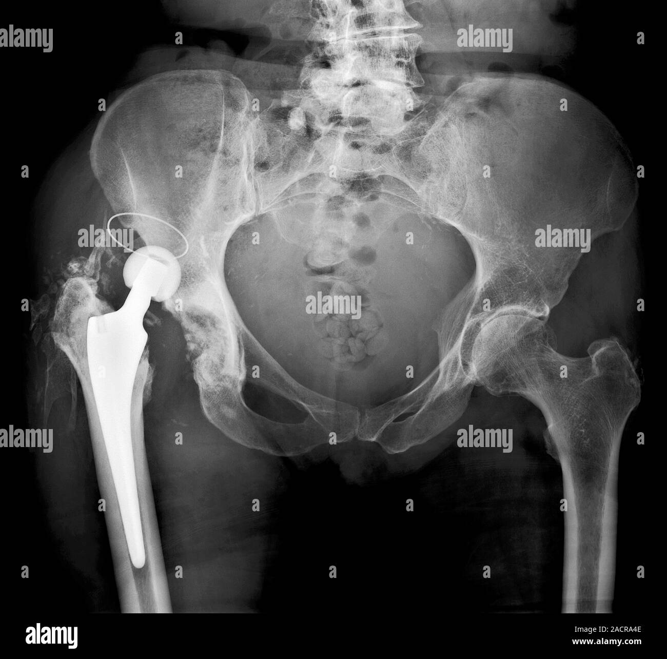 Dislocated hip replacement. Xray of the pelvis of a patient who's total hip replacement of the