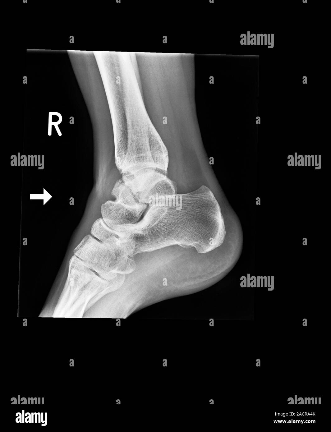 Ankle bone fracture. Xray of the ankle of a patient with a fractured talus (ankle bone Stock