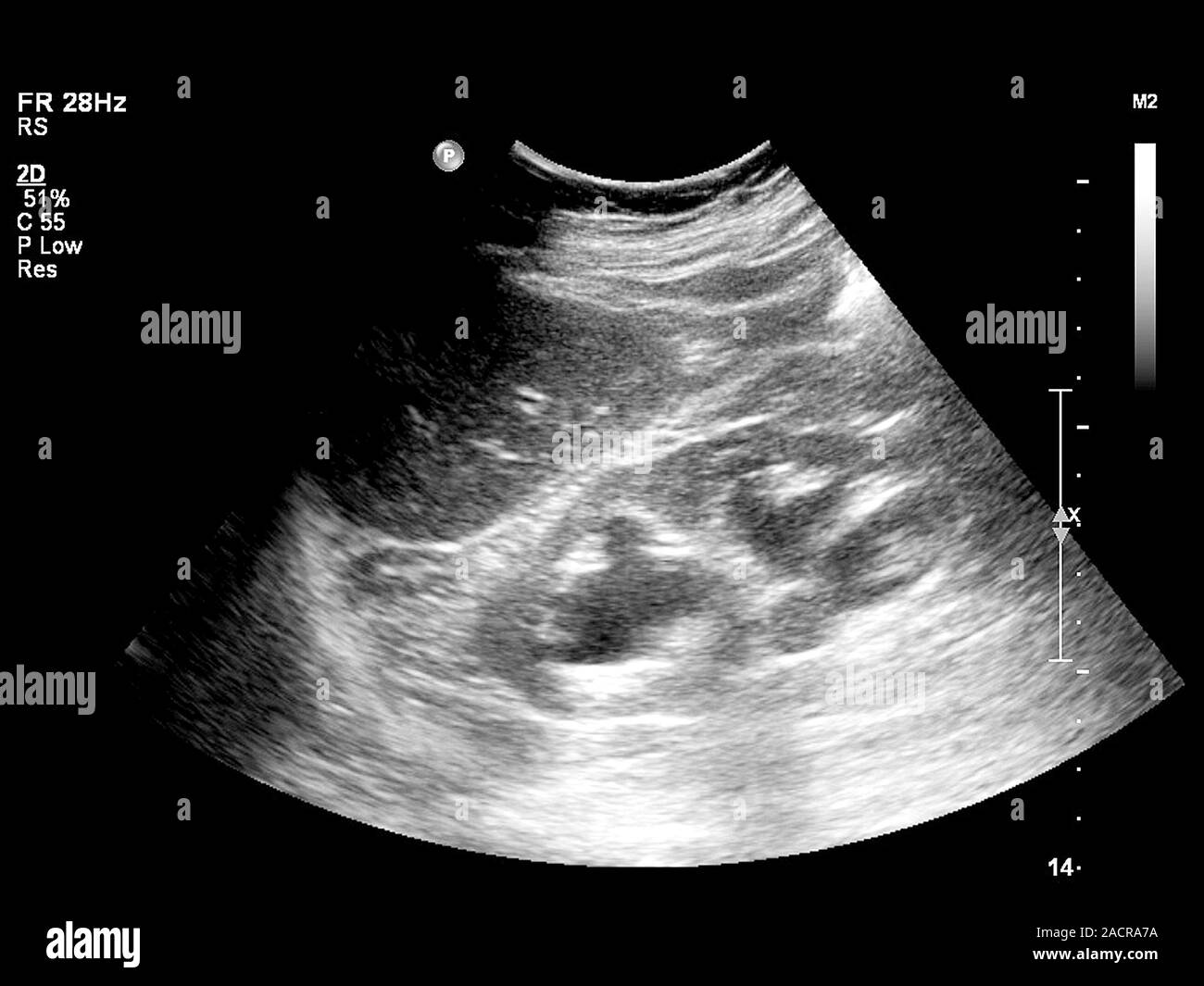 Gallstone. Ultrasound scan of the abdomen of a patient that has a