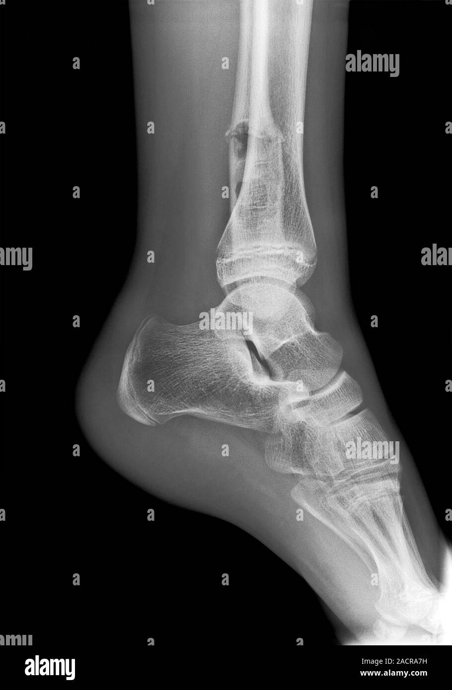 Ankle fracture. Xray of the fractured ankle of a patient. The bone had