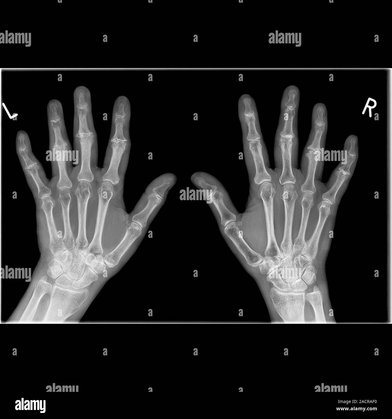 Arthritic hands. Xray of the hands of a 49 year old female patient