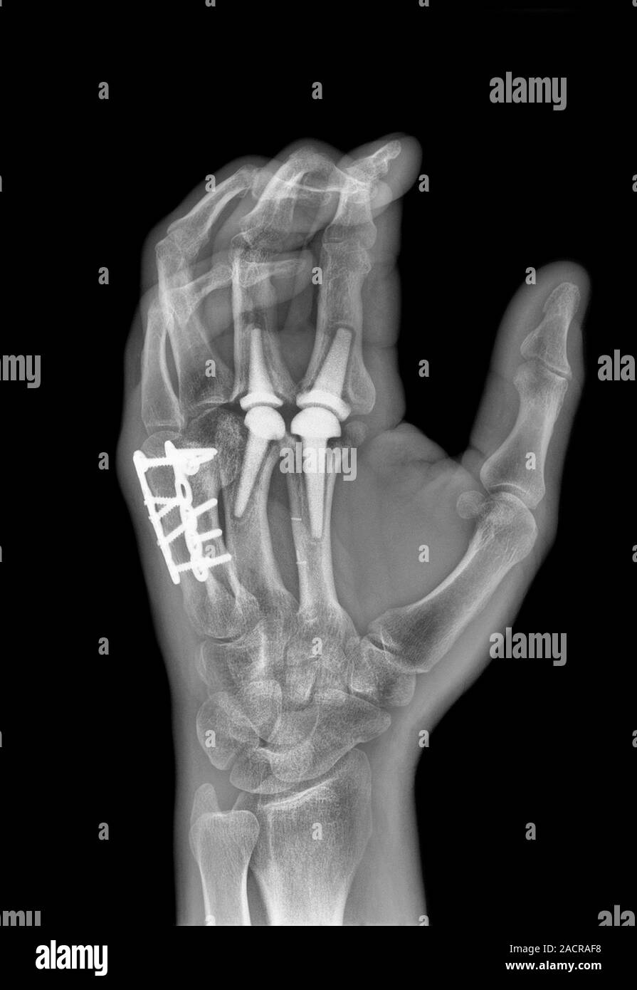 Knuckle replacement. Xray of the hand of a 41 year old male patient