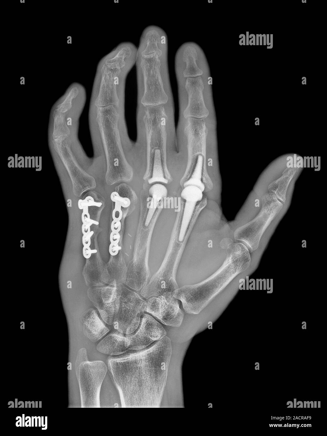 Knuckle replacement. Xray of the hand of a 41 year old male patient