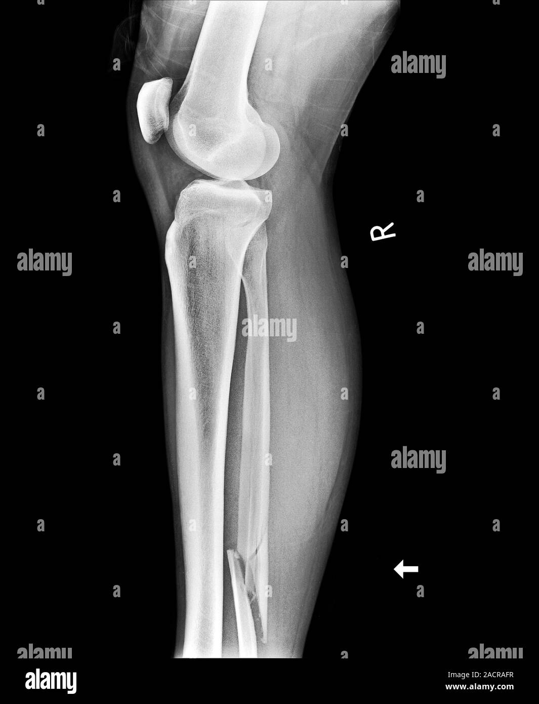 Broken leg. X-ray of the leg of a 32 year old male who has been, image size:1065x1390