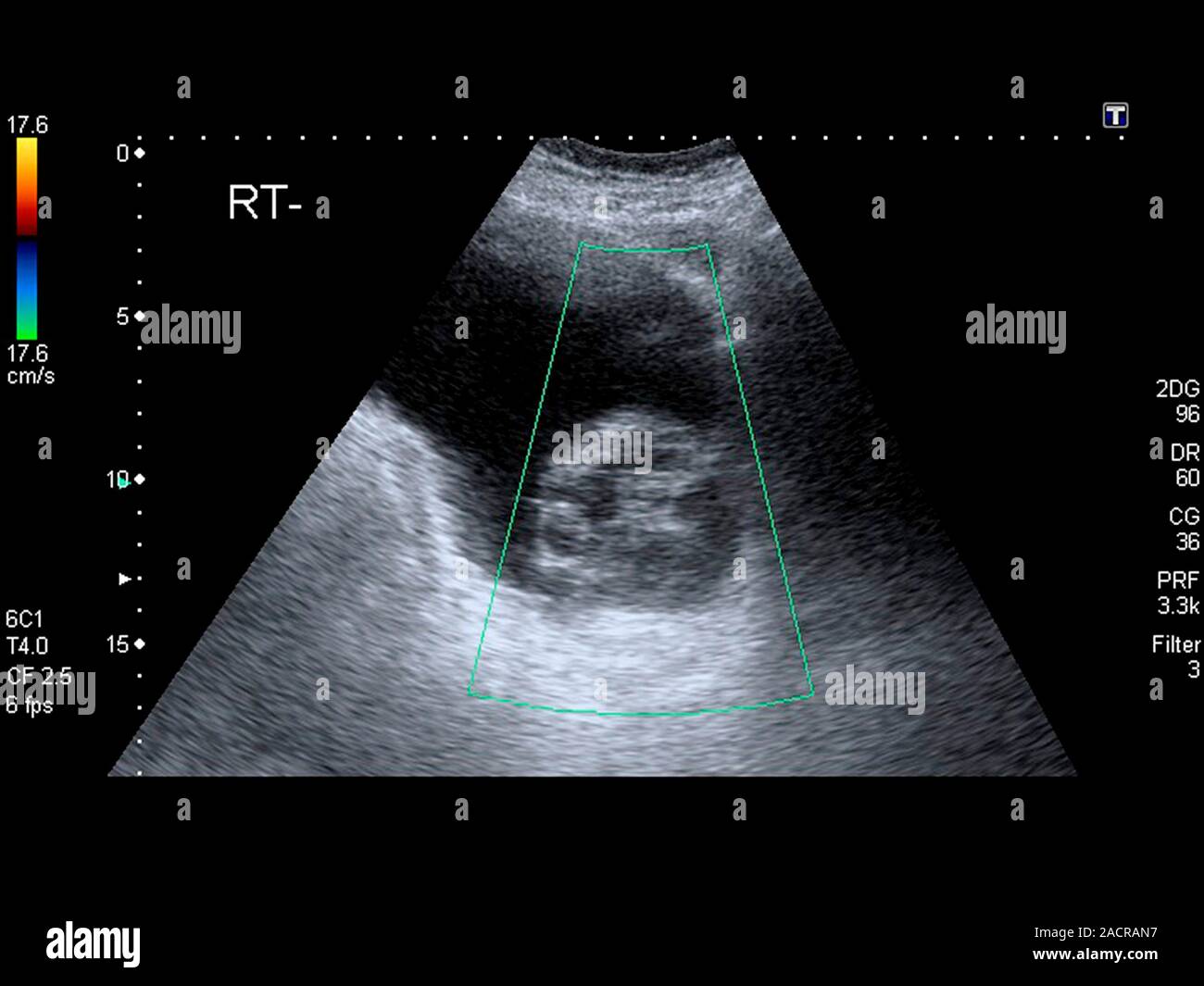 Ovarian cysts. Ultrasound scan of the abdomen of an 85 year old female ...