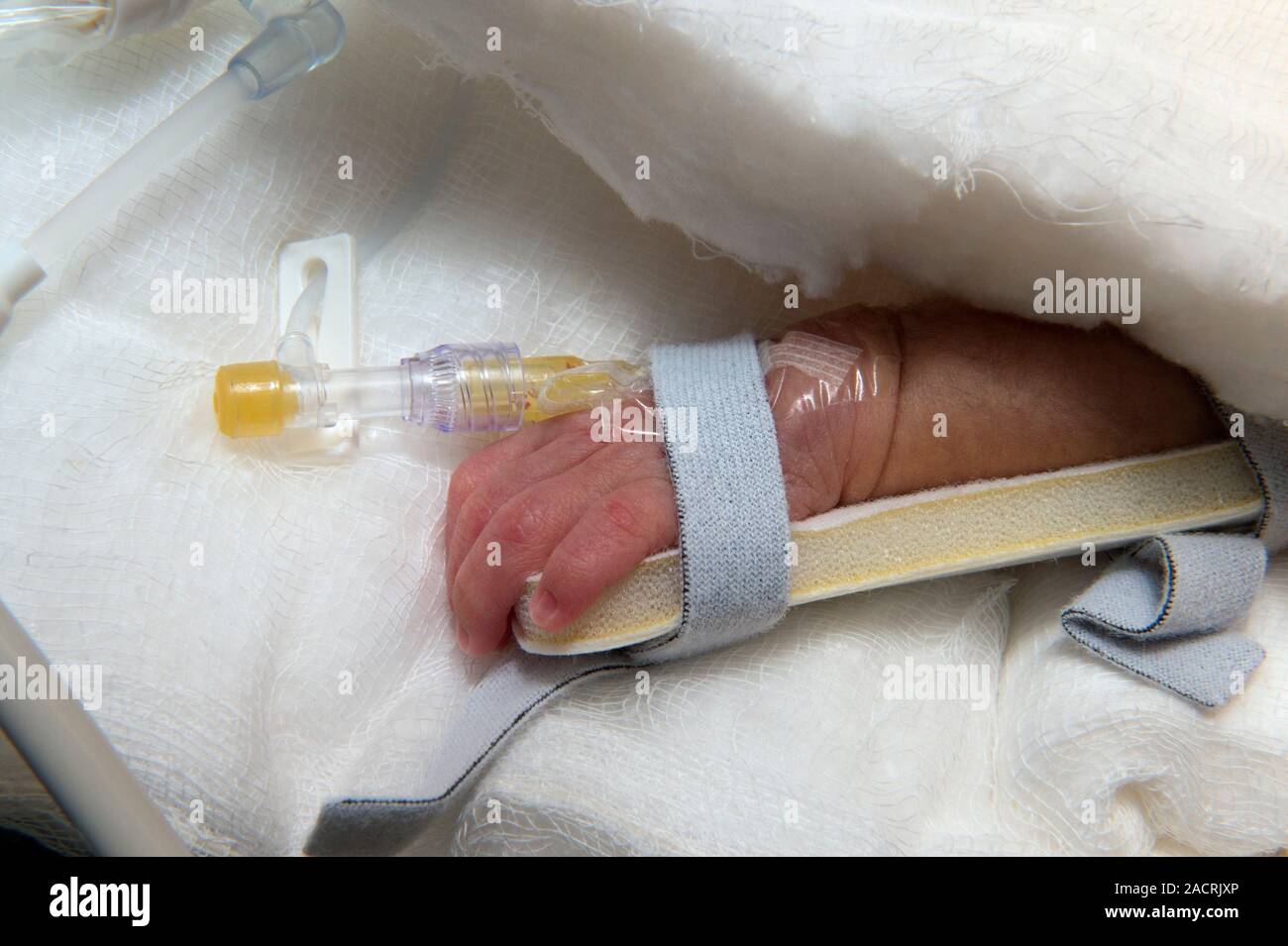 Cannula in neonate's hand. The cannula is attached to a needle at one