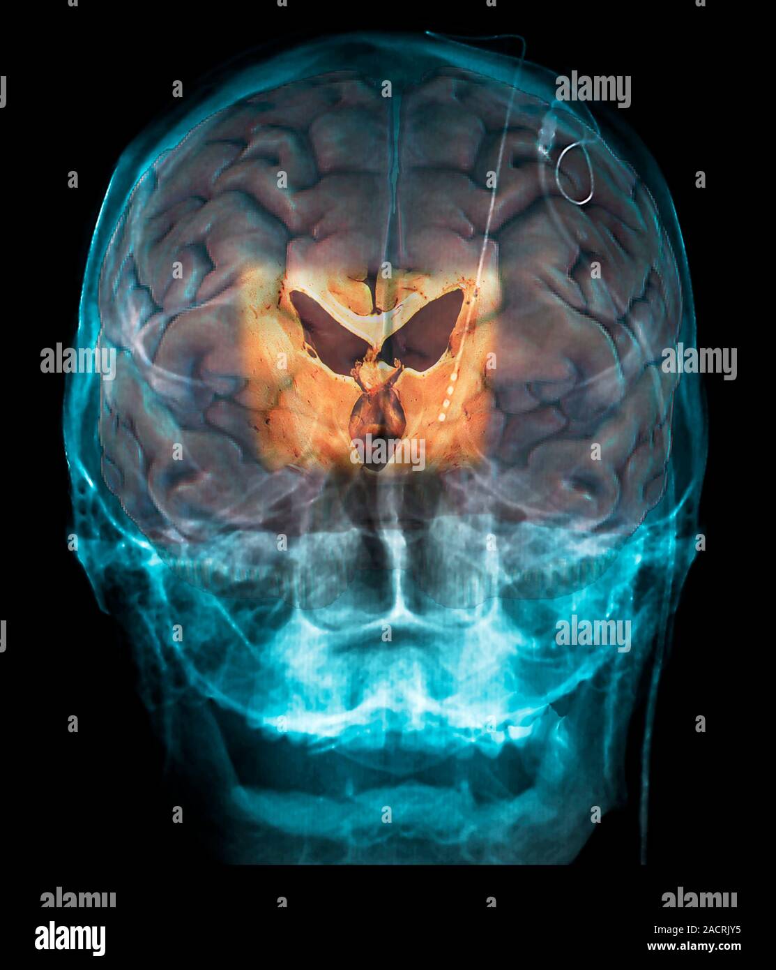Brain implants for Parkinson's disease. Coloured 3D resonance imaging (MRI) scan of the