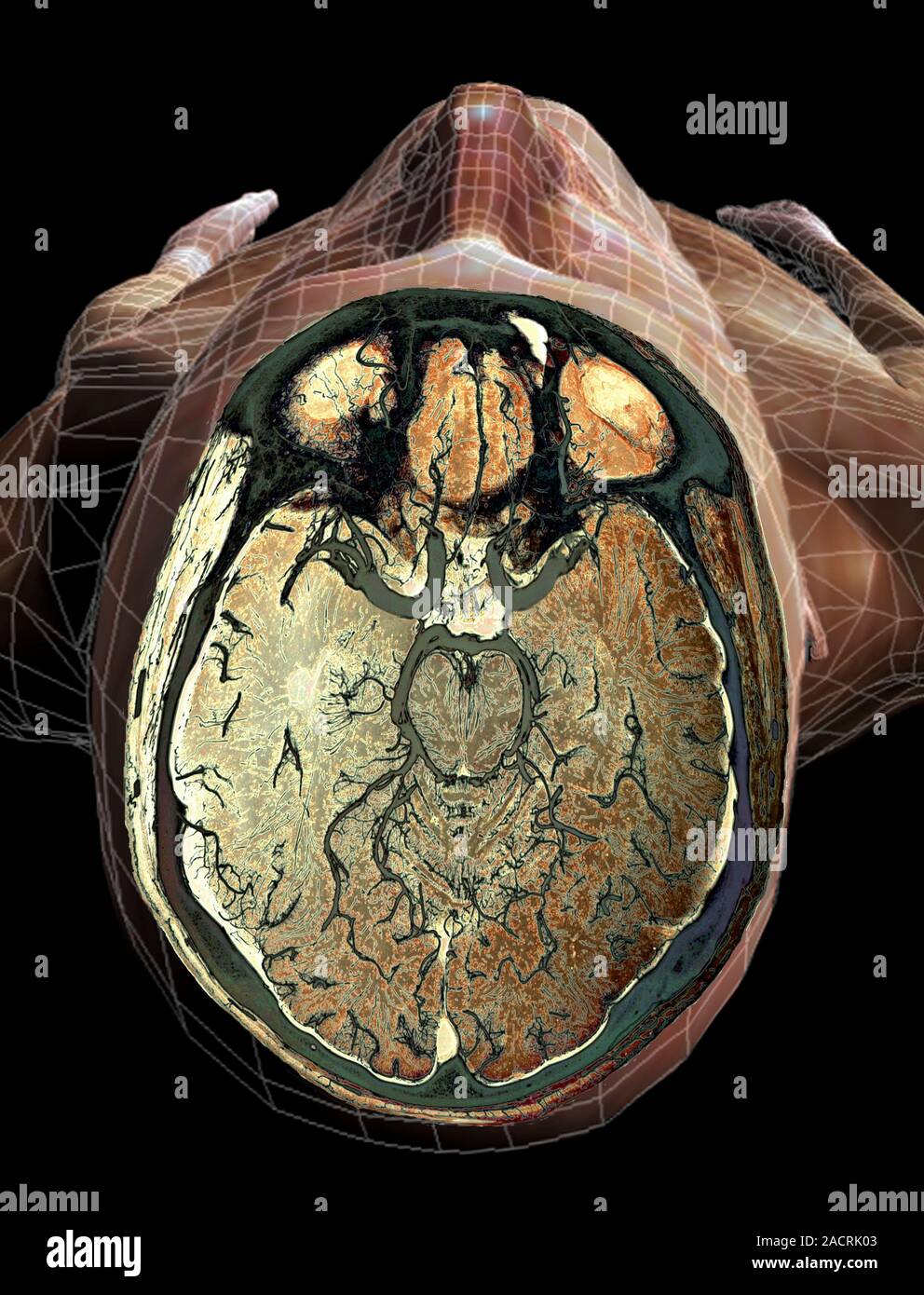 Brain blood supply. Coloured magnetic resonance (MRI) scan of a section ...