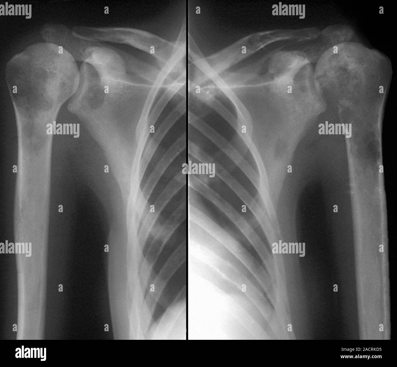Secondary bone cancer. Xray of the shoulders of a 39 year old patient