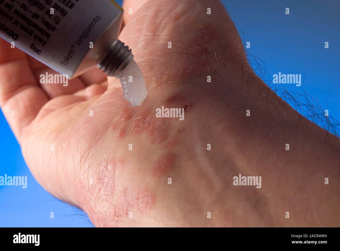 Psoriasis treatment. Male patient using Dovonex ointment on area of