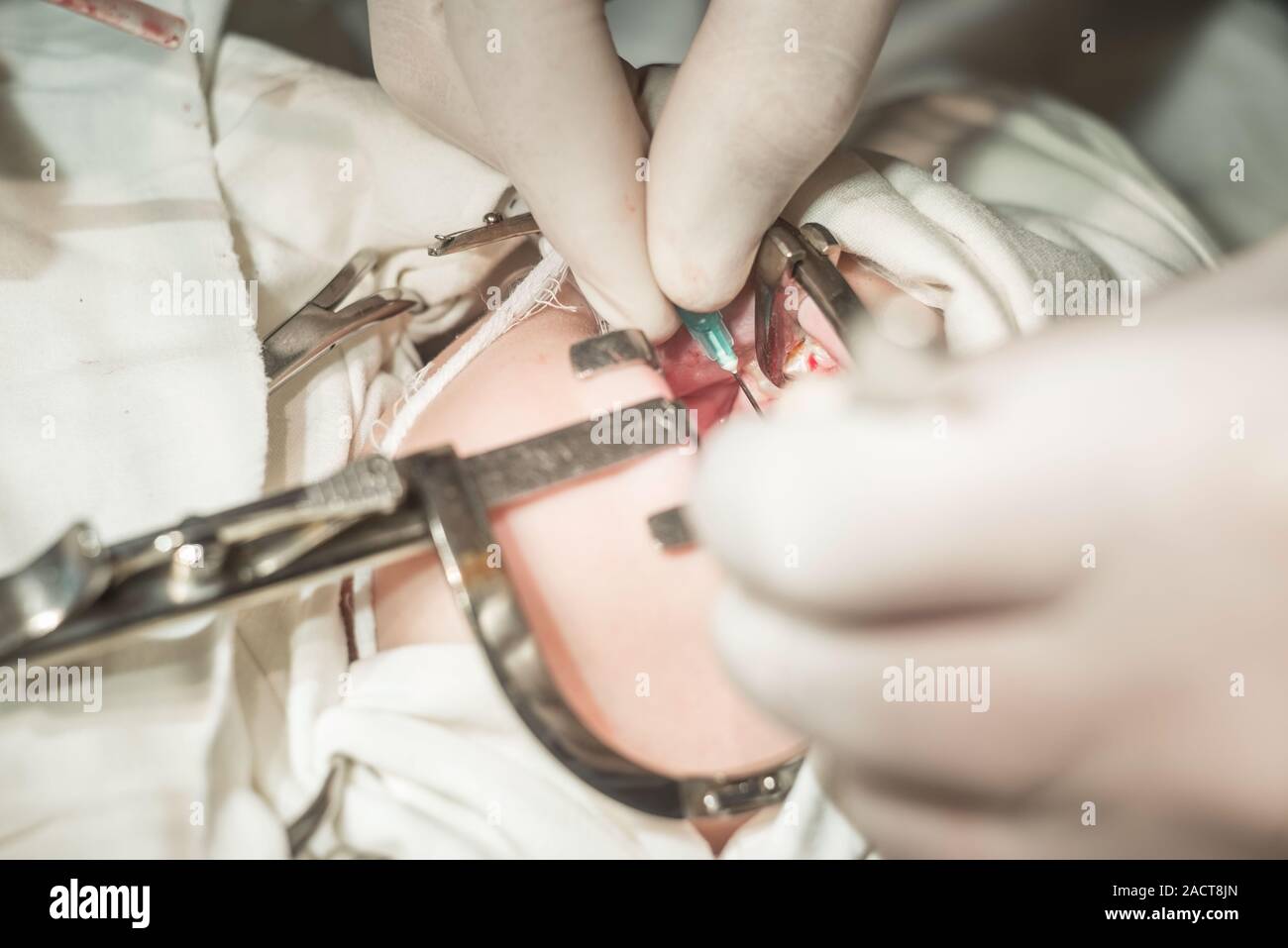 hands of a dentist doctor, closeup. The operation to eliminate the defect of the cleft palate, pathology of the hard palate. The child's mouth is open Stock Photo