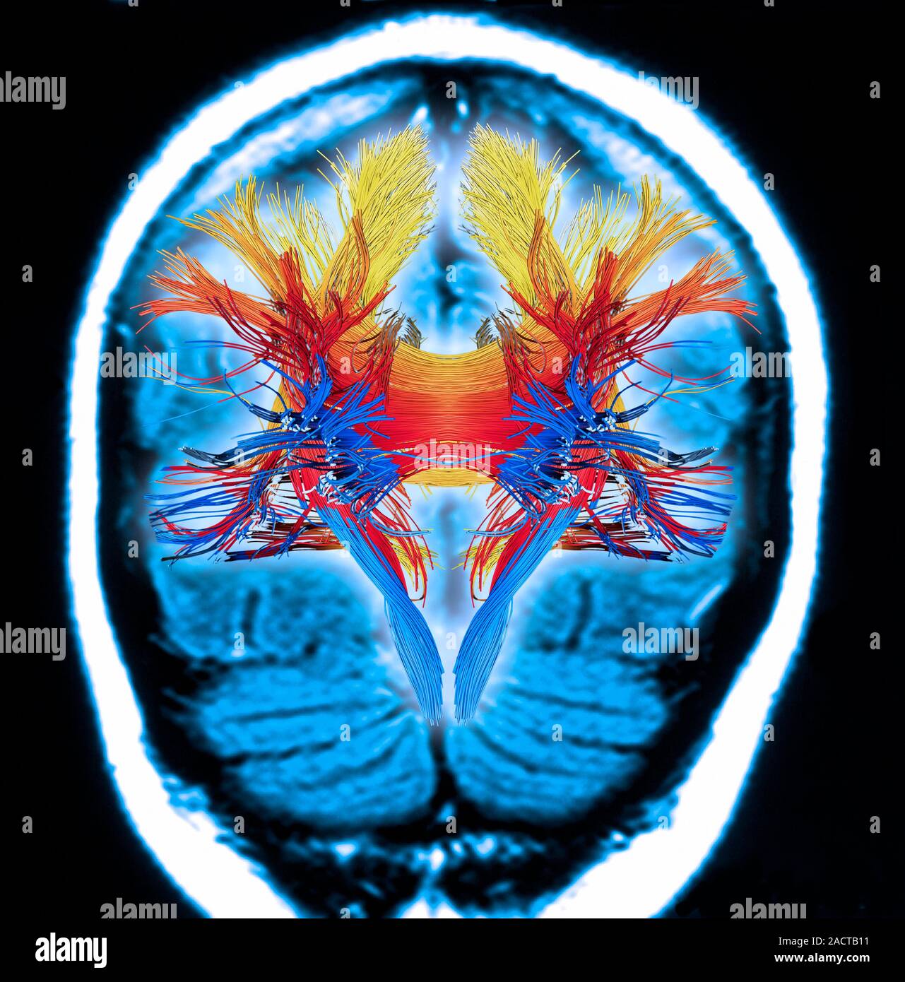White matter fibres overlaid a mri scan of the human head. Computer ...