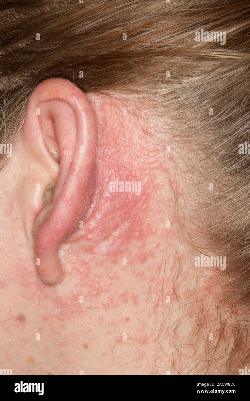 Allergic skin reaction. Closeup of inflamed skin behind the ear of a