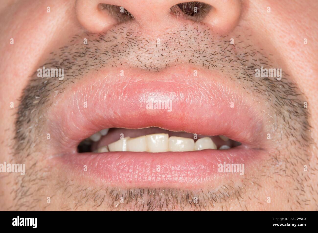 Swollen lip. Closeup of the swollen lip of a 42yearold male patient
