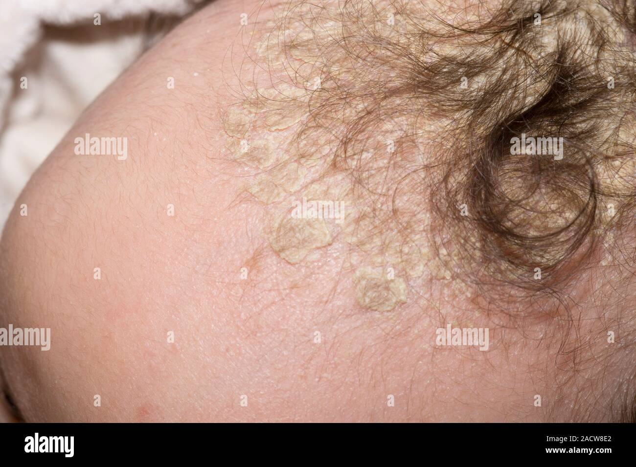 Cradle cap. Closeup of yellow scales of cradle cap (crusta lactea) on the scalp of a fourmonth