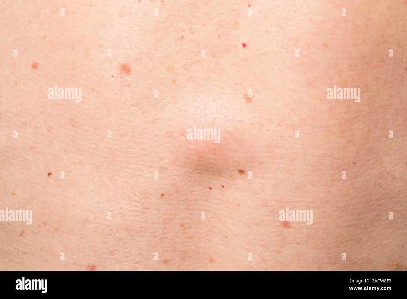 Lipoma on the back. Closeup of a swelling on the back of a 77yearold