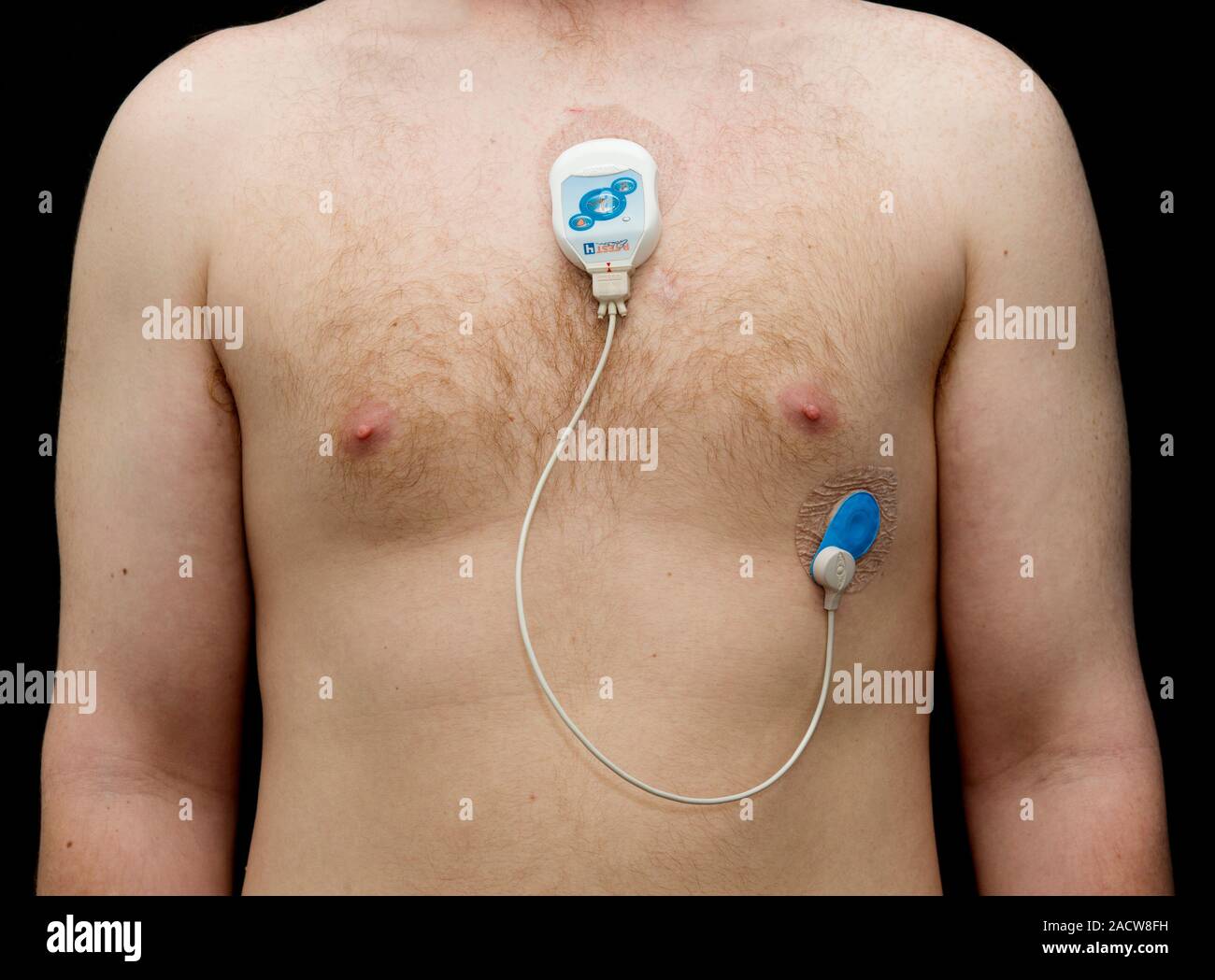 24-hour Holter monitoring: Uses, results, and what to expect