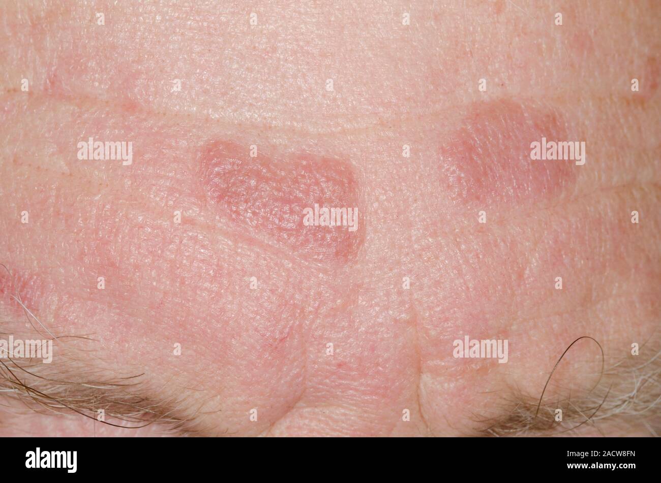 Skin plaques. Closeup of lesions on the forehead of a 70yearold male