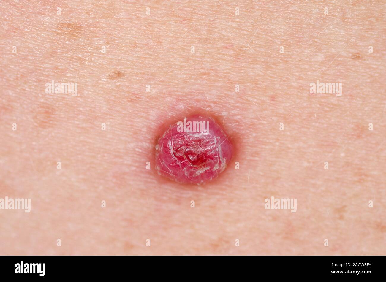 Pyogenic Granuloma Close Up Of A Pyogenic Granuloma On The Skin Of A 42 Year Old Female Patient