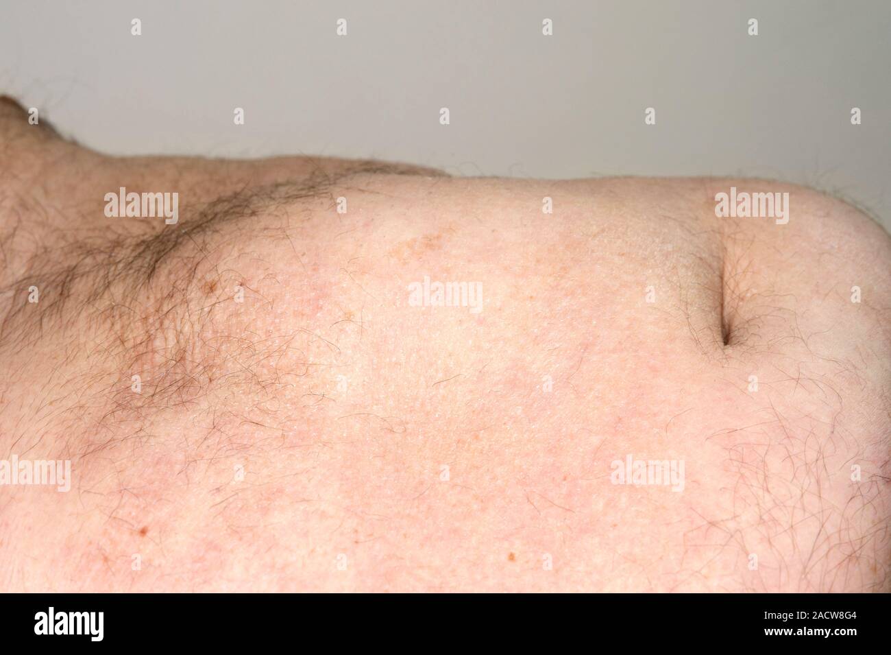 Abdominal hernia. Closeup of the abdomen of an 66yearold male