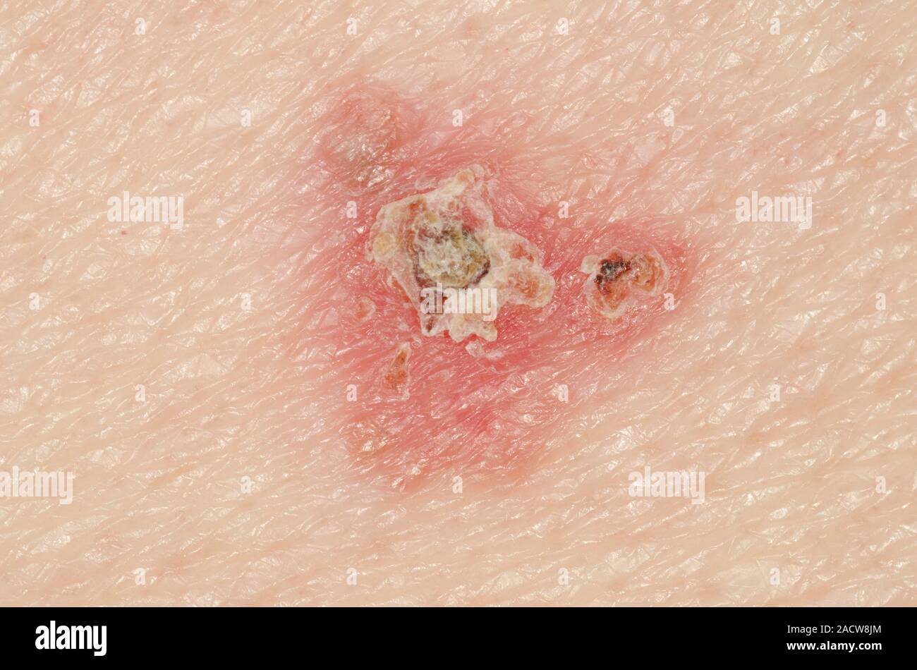 Skin cancer. Closeup of a superficial spreading basal cell carcinoma (BCC), on the back of an
