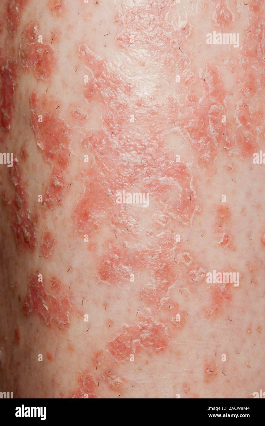 Psoriasis. Closeup of psoriasis on the skin of a 40yearold female