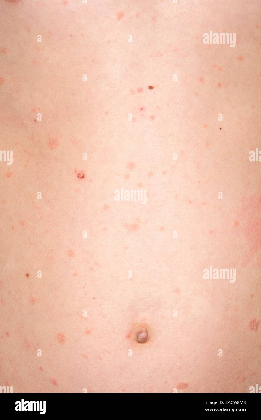 Psoriasis. Closeup of acute guttate psoriasis on the skin of a 12year