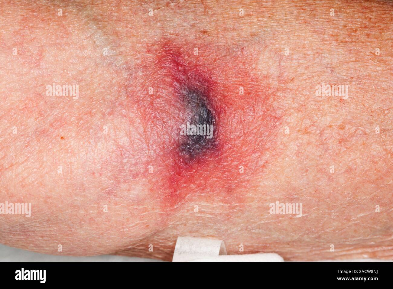 Bruised elbow pit. Closeup of the interior of the elbows of a 79year