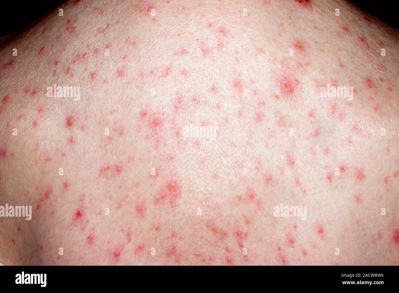 Chicken pox. Close-up of chicken pox rash on the back of an 85-year-old