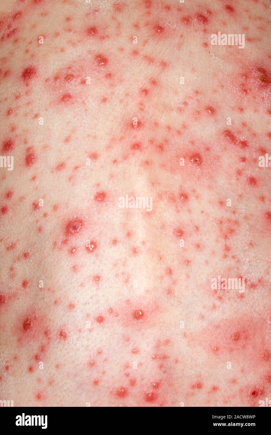 Chicken pox. Close-up of chicken pox rash on the skin of a 3-year-old
