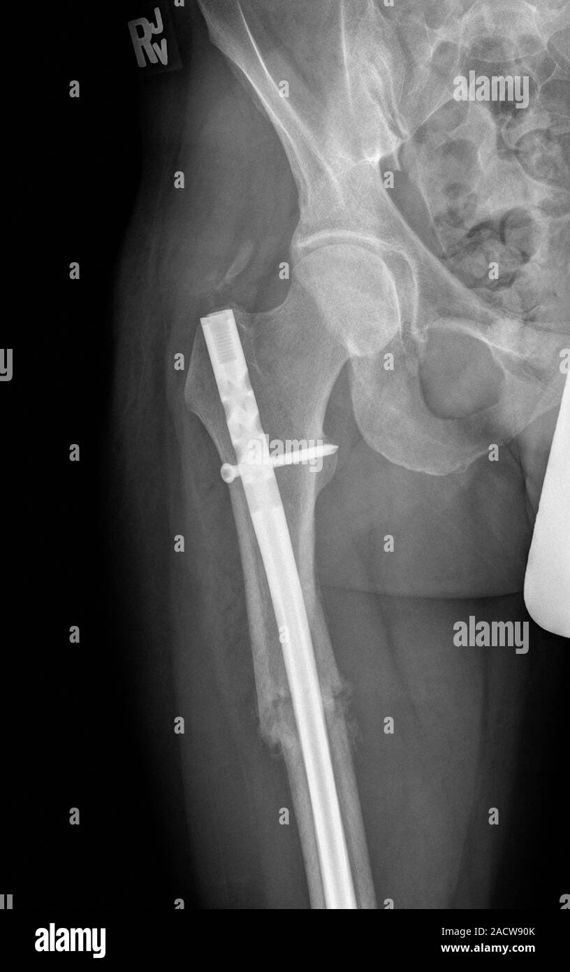 Pinned femur fracture. Xray of a titanium metal rod and screw (white