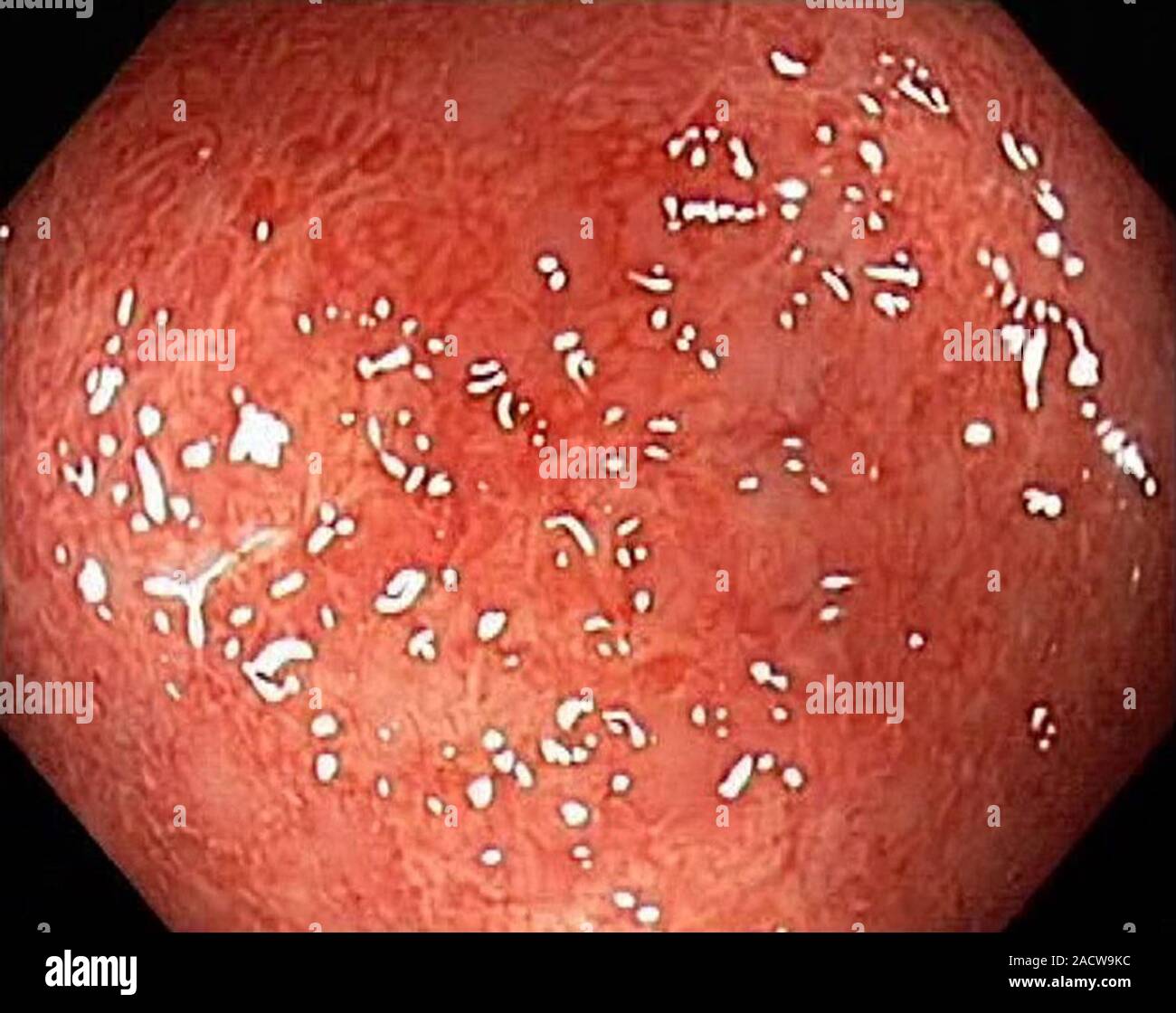 Infectious colitis, endoscope view. Inflammation of the intestines in a