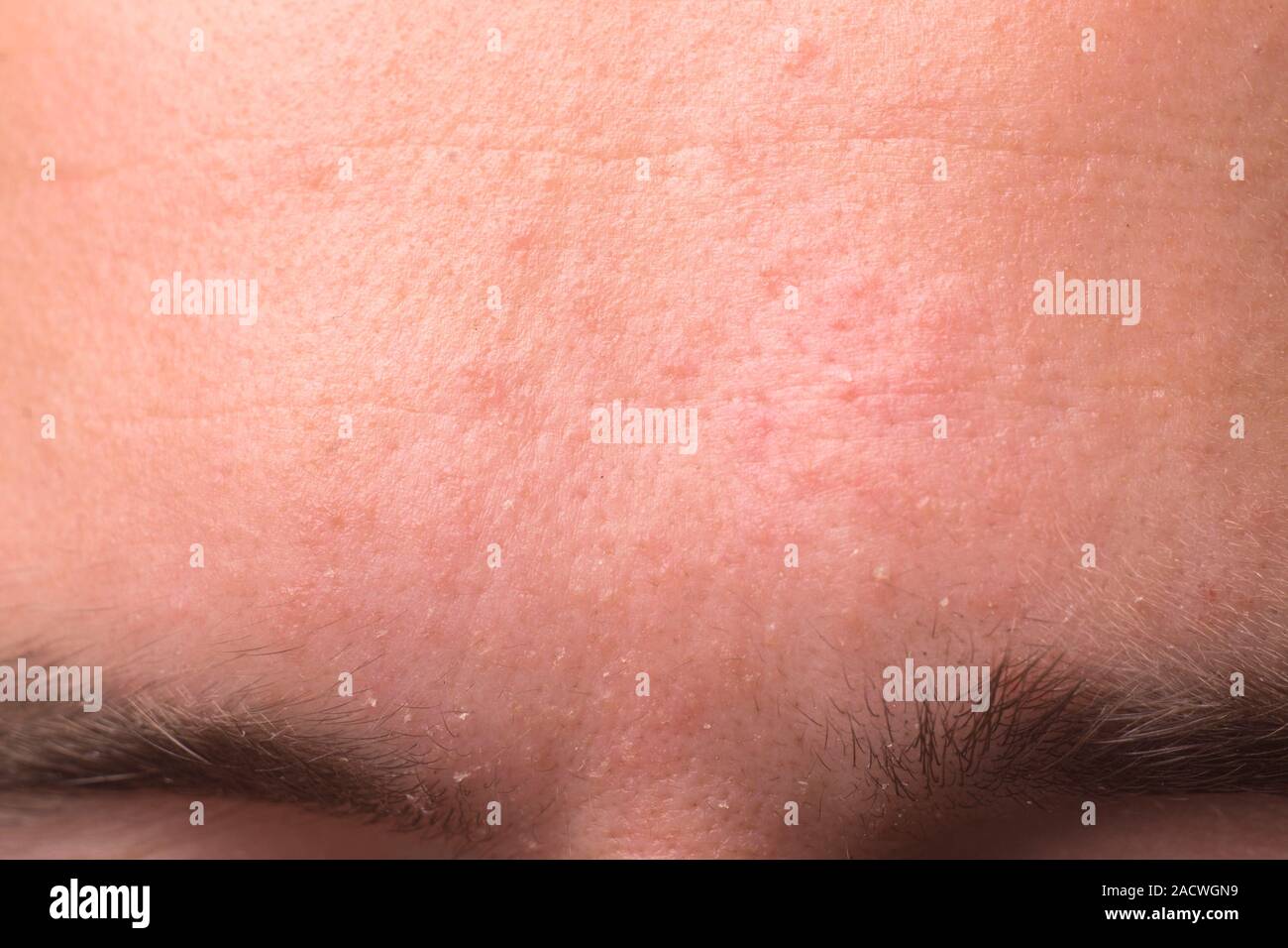 allergic spots in a specific area of the face. Treatment gets wet eczema, psoriasis, streptoderma Stock Photo
