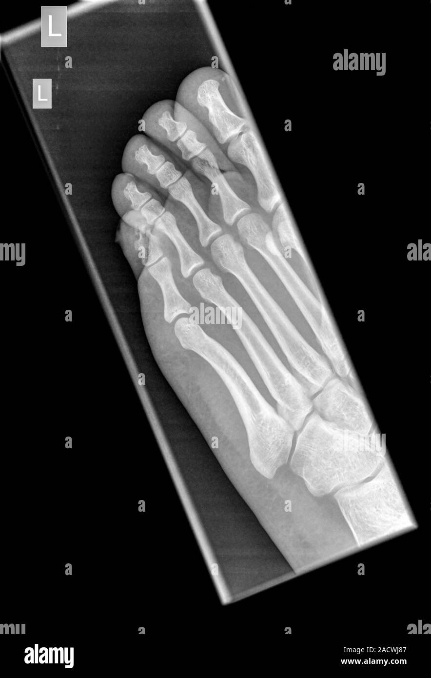xray of a foot showing a fracture in the intermediate phalanx of the