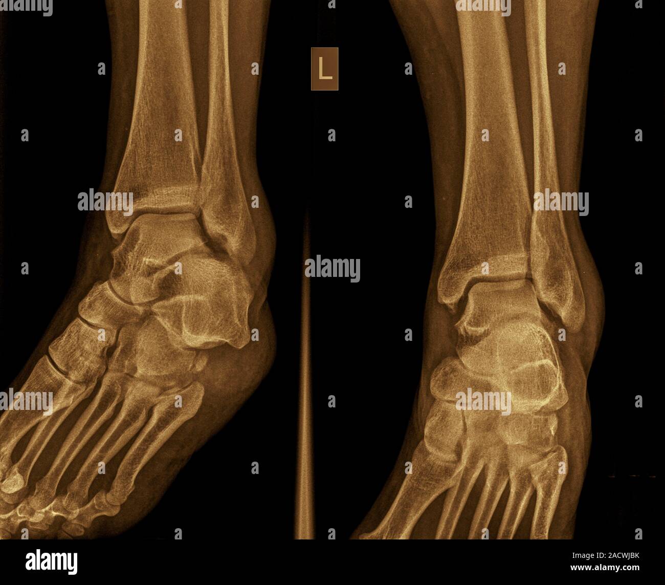 X-ray of a left ankle of a 53 year old female patient with a fractured ...