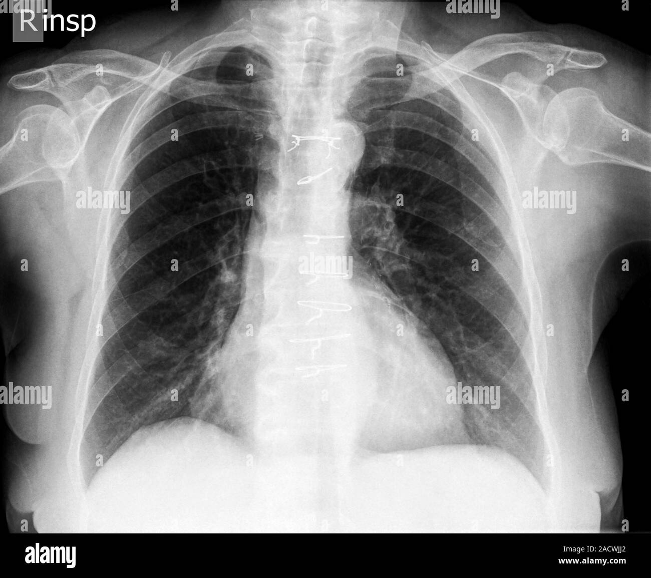 Healthy chest X-ray of a 72 year old female. front view. Stitches from ...