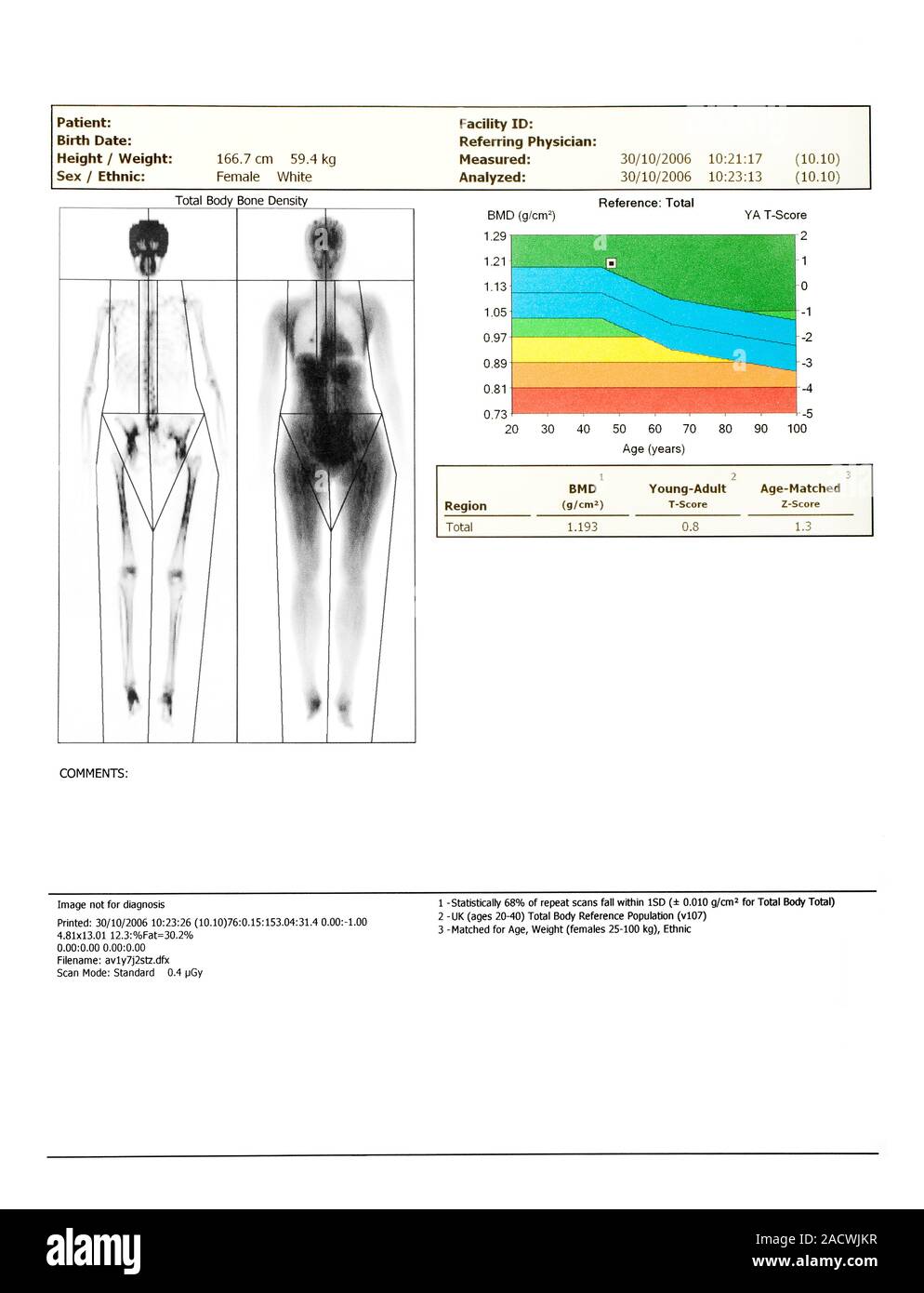 Bone density scan. Results from a DEXA (dual energy Xray