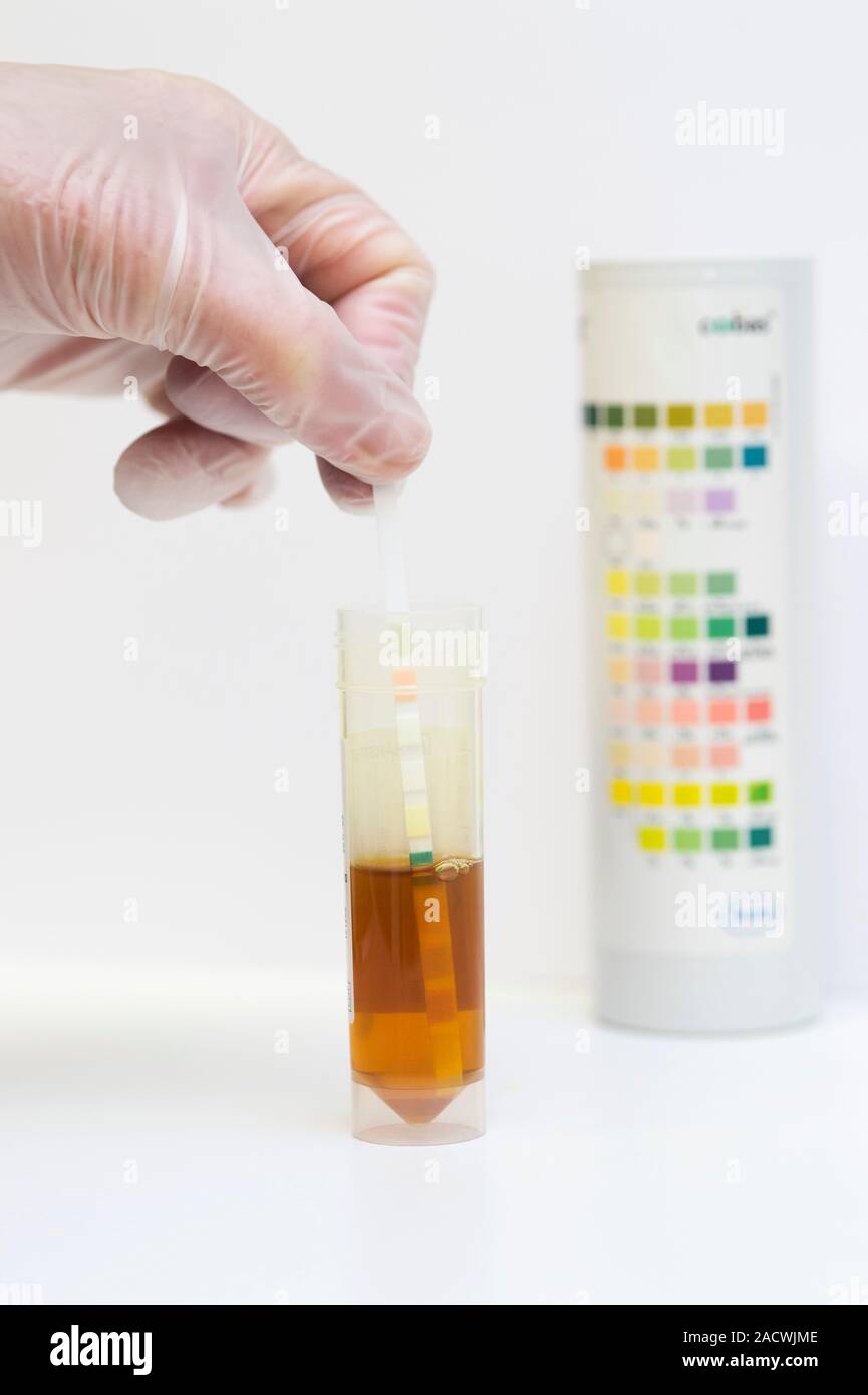 Urine test. Dipstick being placed in a sample of dark urine from a