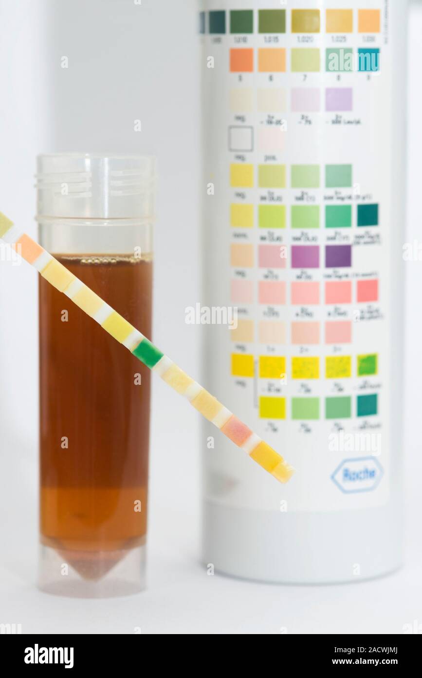 Urine Test Dipstick That Has Been Placed In A Sample Of Dark Urine From A Patient With Jaundice 5333