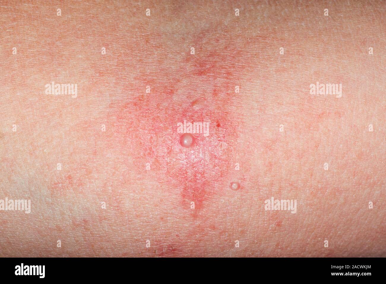 Molluscum contagiosum and eczema. Eczema rash (red) on a 6 year old male patient caused by a molluscum contagiosum infection (blisters). This conditio Stock Photo