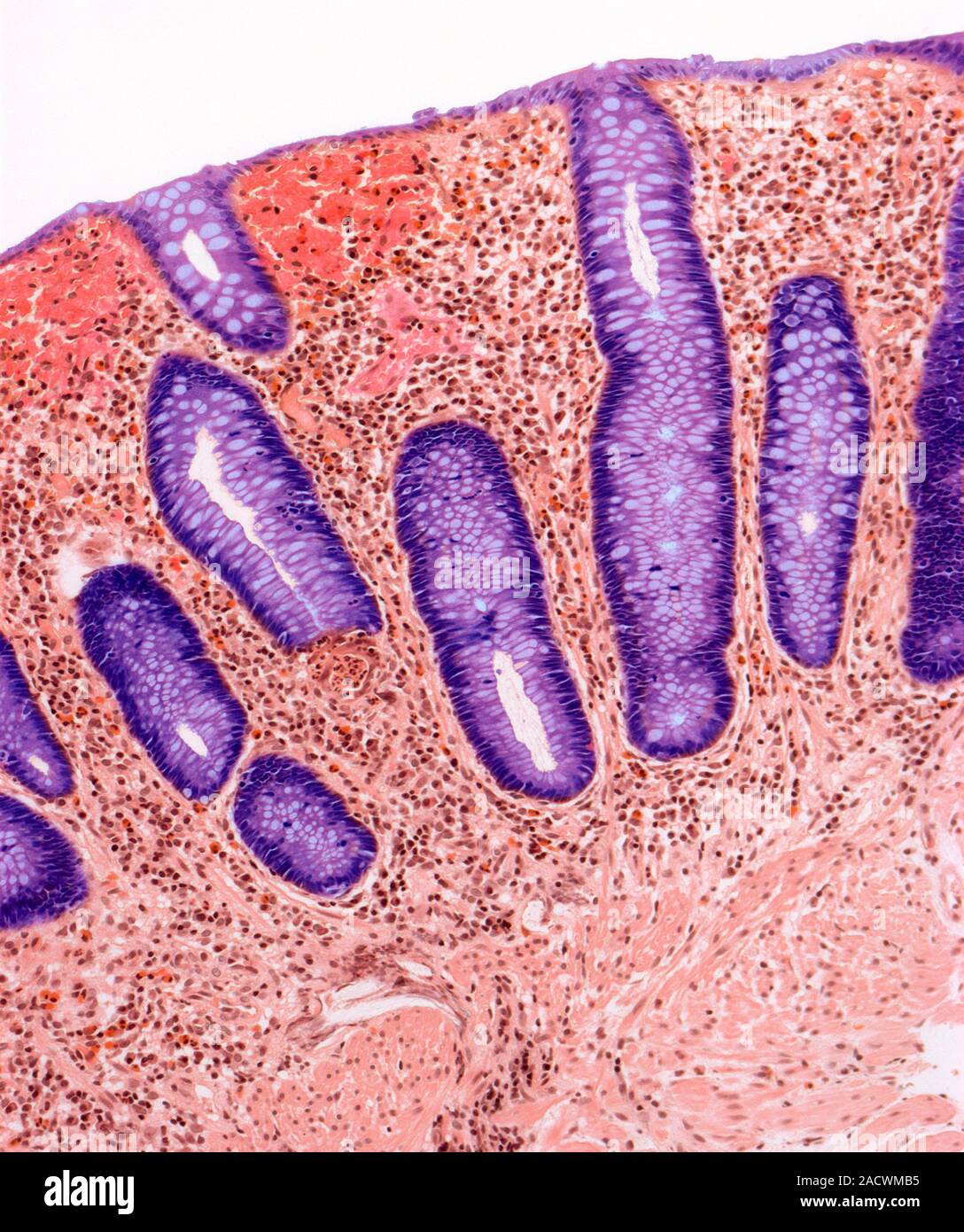 Granuloma Crohn's Disease