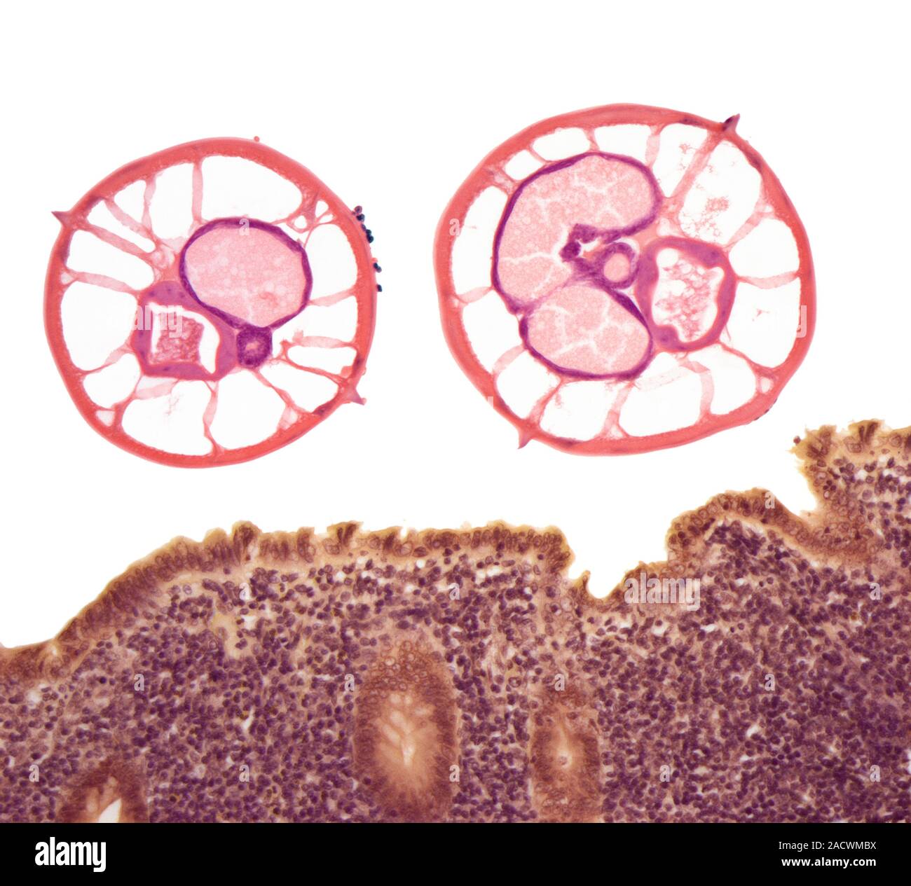 Appendicitis due to threadworm (Enterobius vermicularis) infection ...
