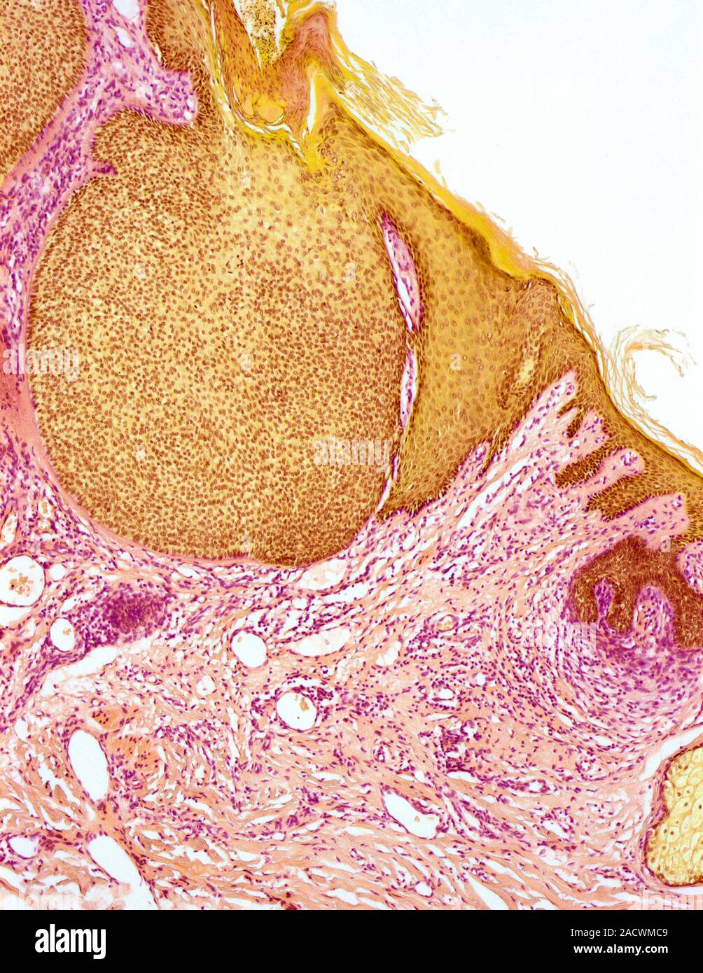 Skin cancer. Light micrograph of a section through a basal cell