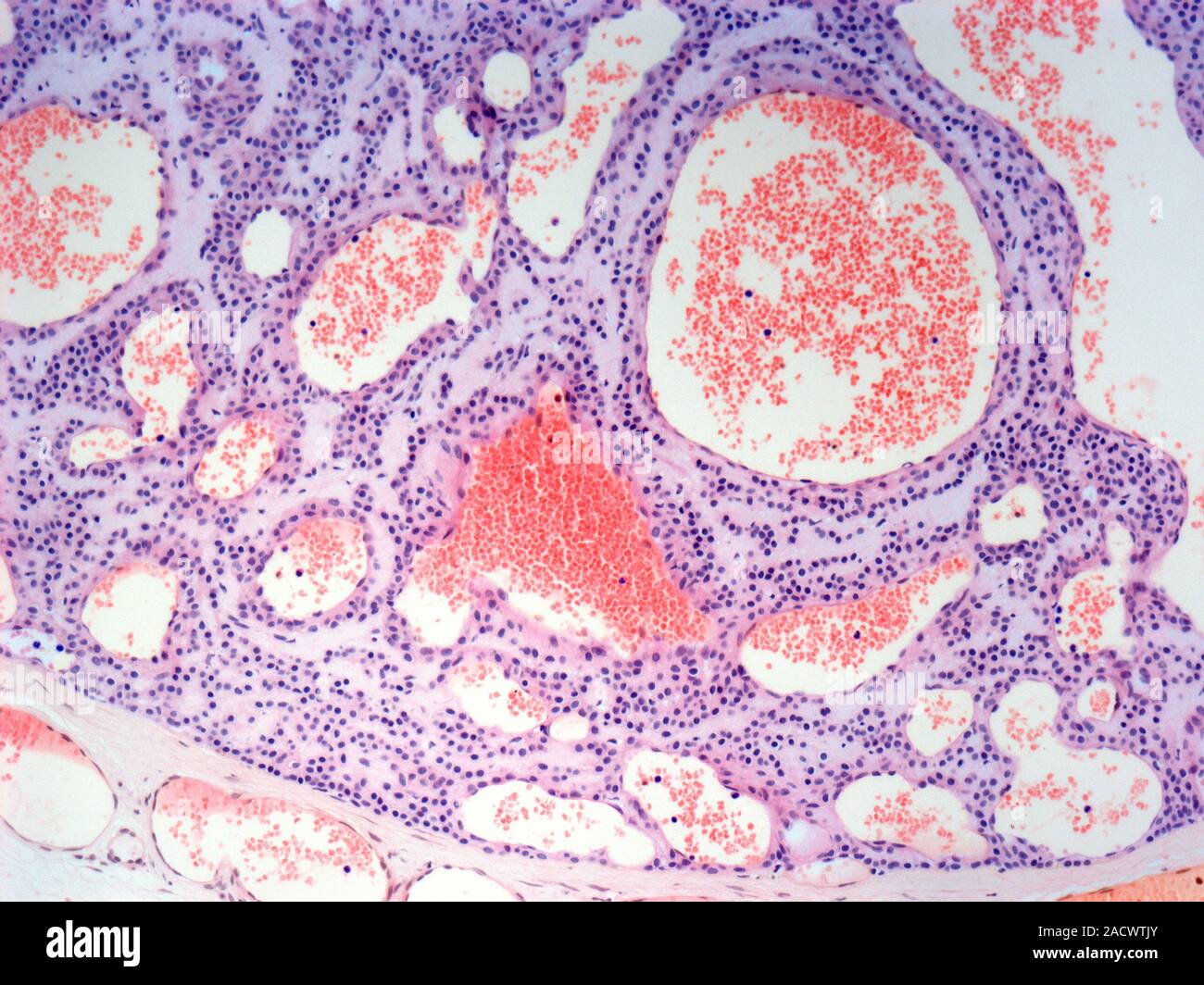 Vascular malformation. Light micrograph of a section through skin ...