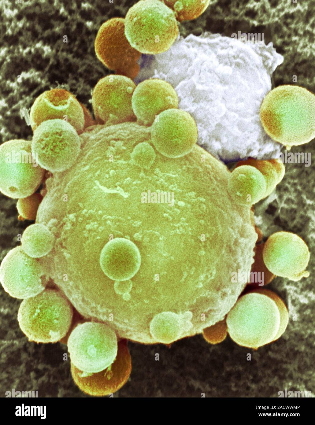 Lymphocyte attacking cancer cell. Coloured scanning electron micrograph ...