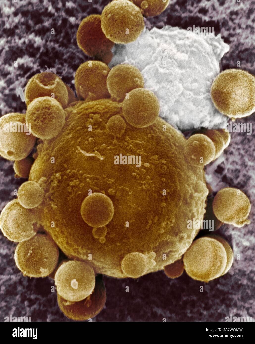 Lymphocyte attacking cancer cell. Coloured scanning electron micrograph ...