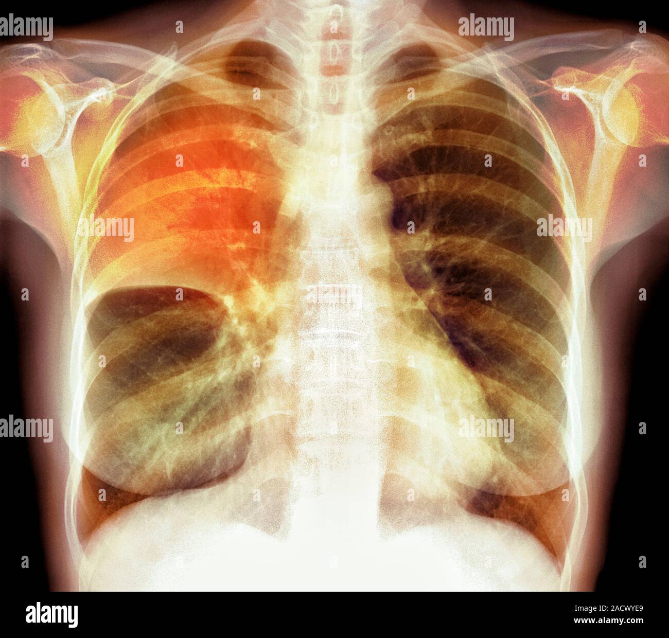 Pulmonary consolidation. Coloured frontal X-ray of the lungs of a 54 ...